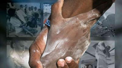 A close-up of two hands clasped together, one coated in a white powder, with black-and-white photos of people in the background.